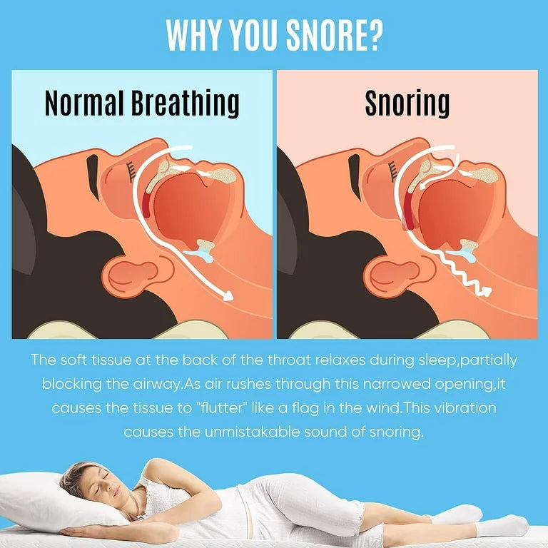 Anti Snoring Device Zquiet